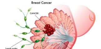 15 Doctor’s Secret Breast Cancer Tips – Women Read This Now!