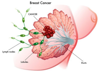 15 Doctor’s Secret Breast Cancer Tips – Women Read This Now!